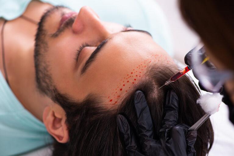 Hair Transplantation 101 Everything You Need To Know About It