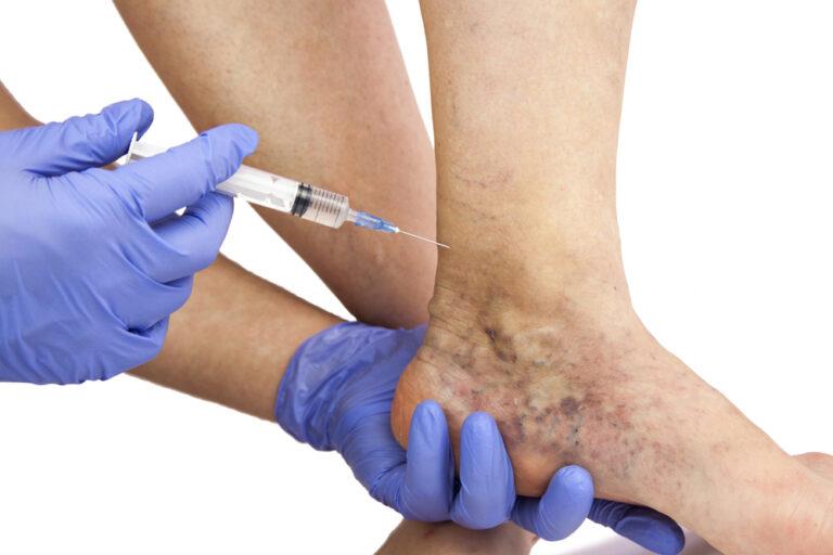Understanding Vein Therapy What Is It, And How Can It Benefit You