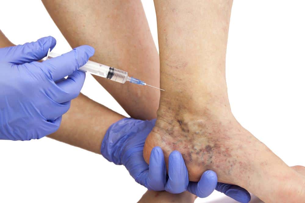 Understanding Vein Therapy What Is It And How Can It Benefit You