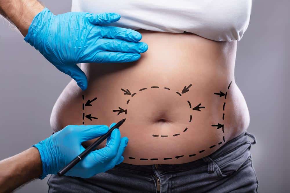 Everything You Need To Know About Lipoplasty What Is It And How Does It Work