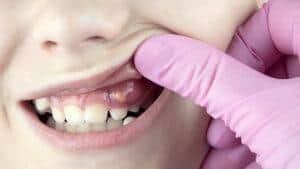 Swollen Gums Causes, Treatment, And Prevention Options