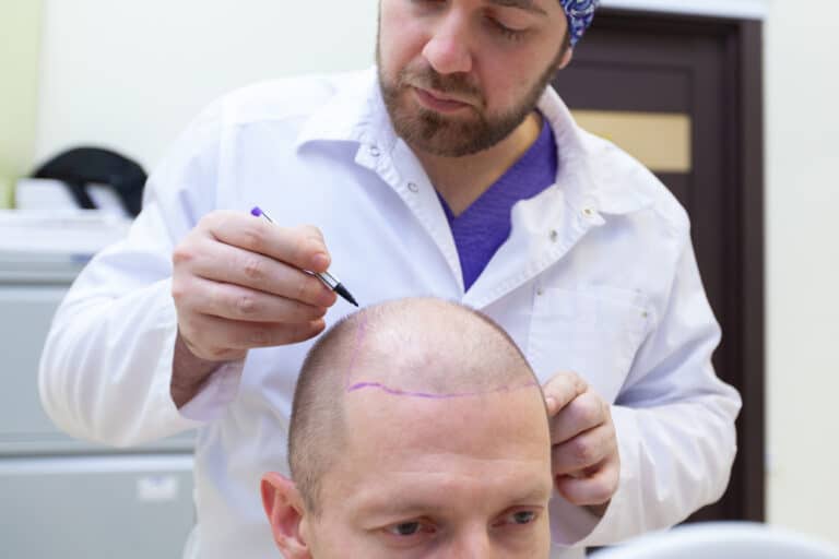 Precision In Hair Restoration Unraveling The Art And Science Of Follicular Unit Extraction (FUE)